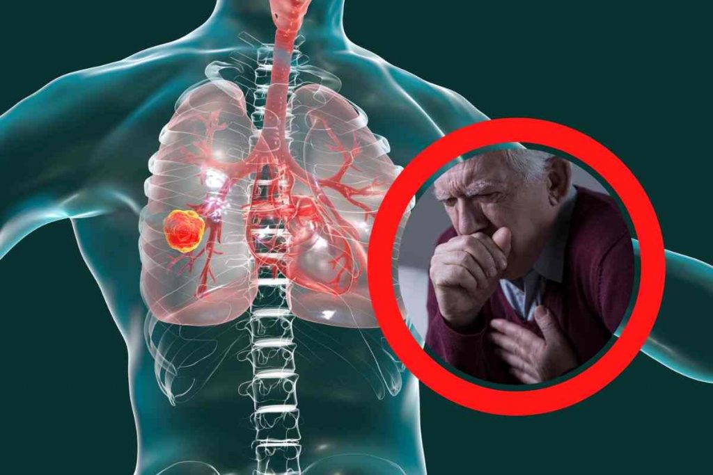 Cancro Ai Polmoni Ecco Quali Sono I Sintomi Che Non Dovresti Cancro Ai Polmoni Ecco Quali Sono I Sintomi Che Non Dovresti