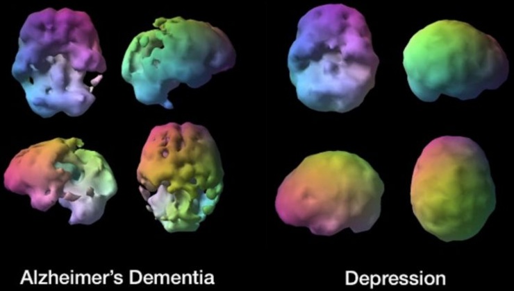 depressione o alzheimer